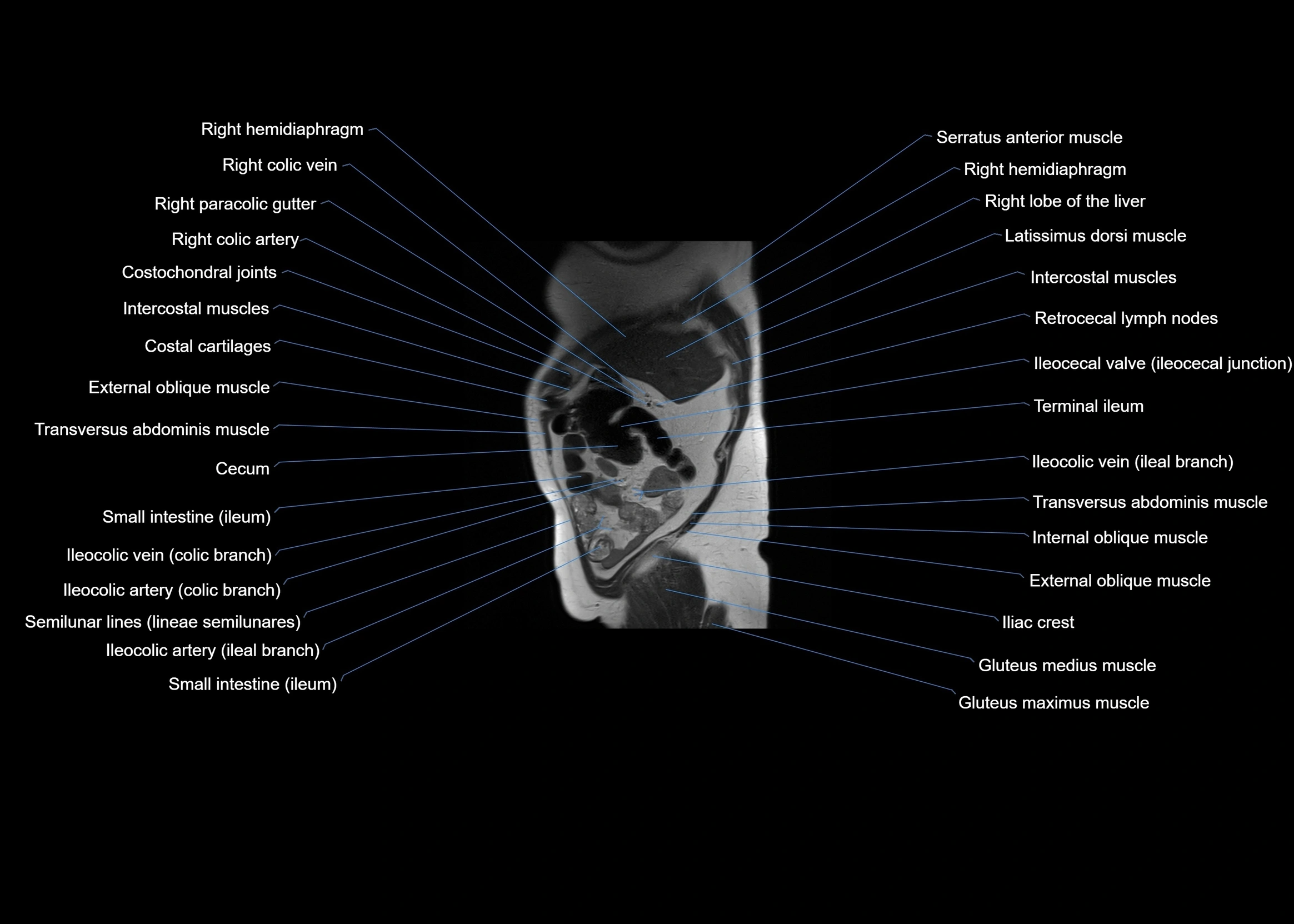 MRI abdomen sagittal cross sectional anatomy  radiology  image-img-00001-00012.webp